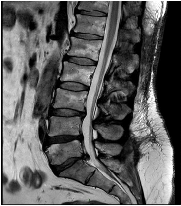 Cauda Equina Cavernoma at level L1 Concurred with Intervertebral Disc Herniation at Level L5-S1: A C...